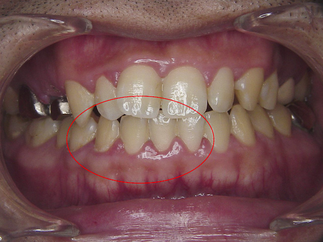 歯肉 炎 治し 方