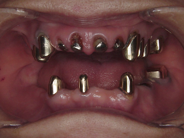 症例 17／61歳 女性 治療前 義歯撤去